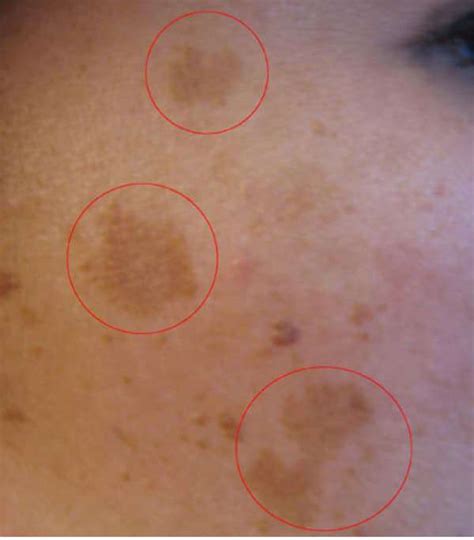 臉頰黑斑|黑斑 (Melasma)